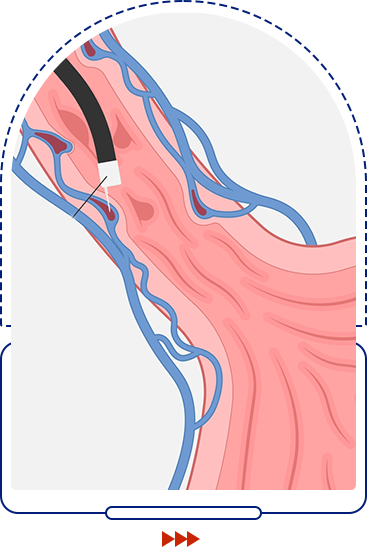 APC & EVL Banding icon
