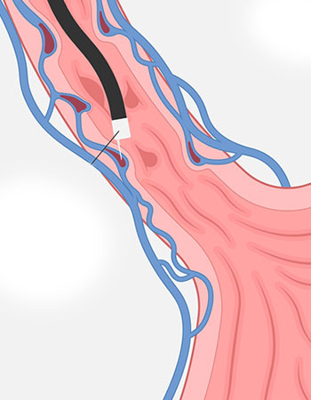 APC and EVL banding procedure for GI bleeding in Vijayawada