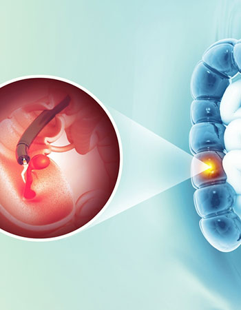 Colonoscopy procedure for colon examination in Vijayawada