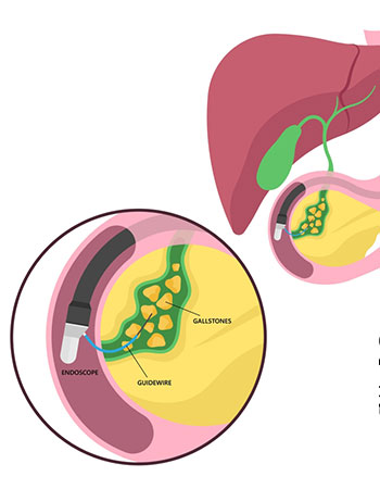 ERCP treatment procedure at Nalini Gastro Center Vijayawada