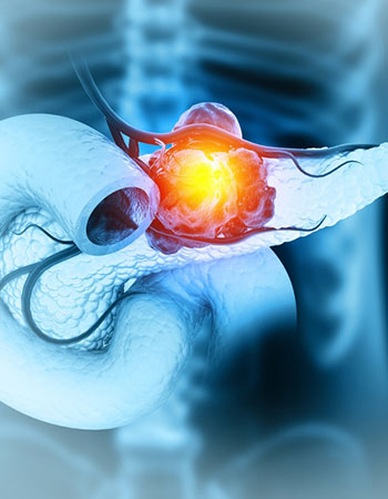 Pancreatitis Treatment in Vijayawada